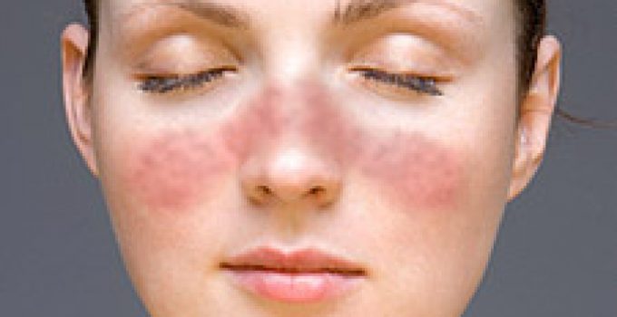 Systemic Lupus Erythematosus-Causes-Symptoms-Diagnosis-Treatment-Homeopathic Treatment-Best Homeopathic doctor-Dr Qaisar Ahmed-Al-Haytham clinic-Risalpur-KPK-Pakistan