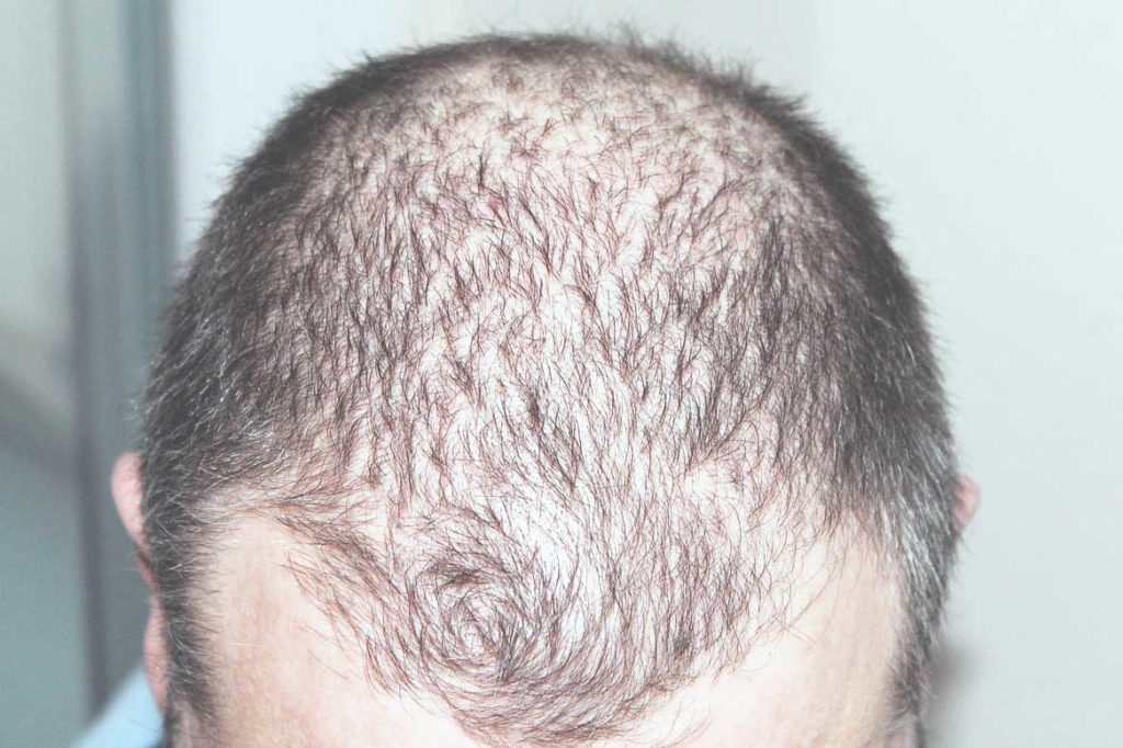 Hair Loss Treatment And Possible Baldness Cure - 2023